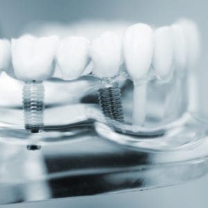 Multiple Dental Implants procedure in Hoffman Estates, IL