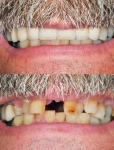 hoffman estates, illinois dental implants