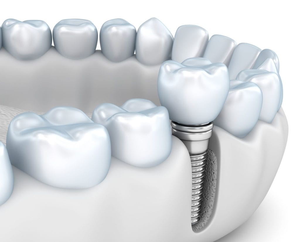 Jawbone Health with Dental Implants