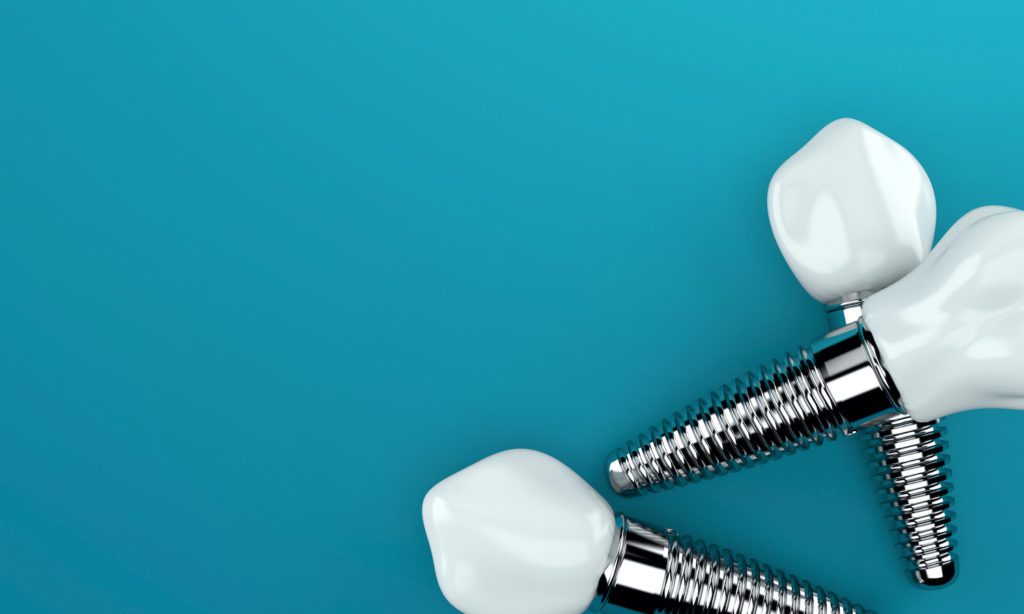 affordable dental implants in schaumburg, illinois