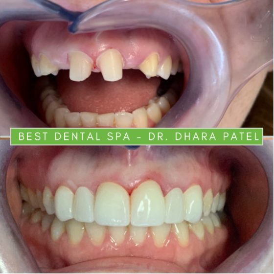 Before and after a dental bridge procedure at Best Dental Spa