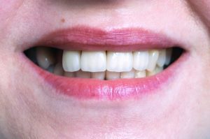 replace missing teeth with restorative dental treatment