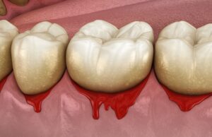 treat gum disease with periodontal therapy