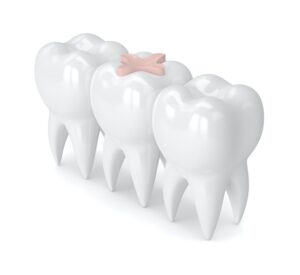dental fillings treat cavities