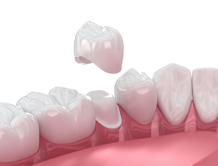 Understanding why your dentist may suggest a dental crown can empower you to make informed decisions about your oral health care.