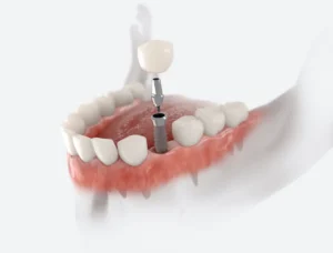 Can You Get Dental Implants If You Smoke? in Hoffman Estates, IL