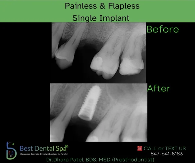 π¦· Single Implant placement π¦·
At Best Dental Spa, we specialize in dental implant placement and restoration services, providing a permanent, beautiful solution for missing teeth.
Schedule your appointment today!
π² 847-641-5183
π2505 W Golf Rd, Hoffman Estates, IL 60169
#dental #dentalimplants #dentalhealth #office #hoffmanestates #dentistry #dentistryworld #chicago #oralhealthcare #implants #implantsurgery