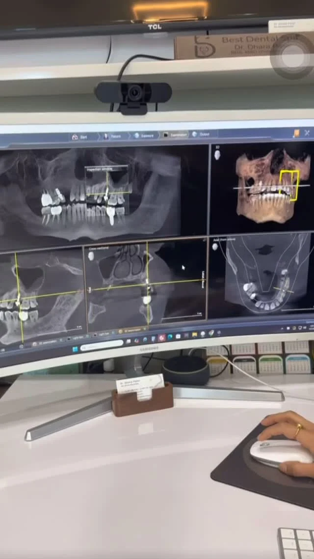 Single tooth implant placement 🦷🪄 

#dentalimplants #implantdentistry #dentalspecialist #dentist #hoffmanestates #schaumburg #localdentist