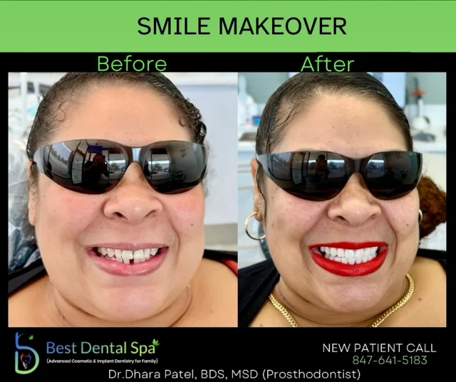 ✨ New Smile, New Confidence! ✨
Say goodbye to stained, chipped, or uneven teeth—your dream smile is just a makeover away! 😁💫

From whitening to veneers, Invisalign, and more, we design your smile to match your unique style. Personalized. Natural. Stunning.

📸 DM us for a free smile consultation or tap the link in bio to book!
#SmileMakeover #SmileGoals #CosmeticDentistry #BeforeAndAfterSmile #Invisalign #Veneers #ConfidenceStartsHere #smiletransformation #hoffmanestates #schaumburg #smile #changingsmileschanginglives #dentist #bestdentist #dentista #life