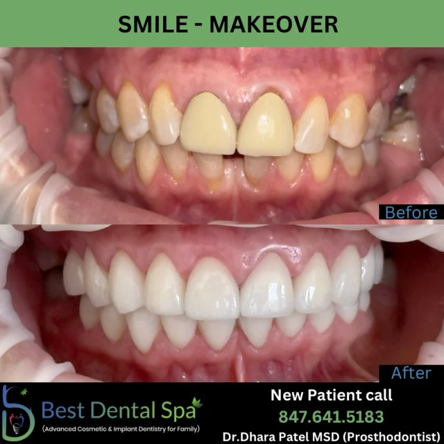 Smile make over … in just 2 appointments
Who is ready for Summer Smile ???
.
.
.
Schedule an appointment with us
📲 (847) 641 5183
📍 2505 W Golf Rd, Hoffman Estates, IL
#smile #smiletransformation #smilemakeover #changingsmile #changingsmilechanginglives #happy #hoffmanestates #schaumburg