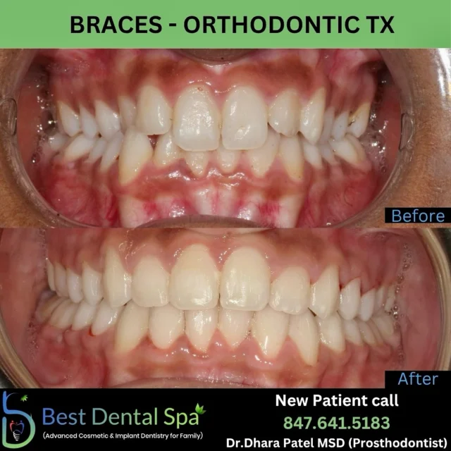 🦷✨ SMILE TRANSFORMATION ✨🦷
Braces didn’t just straighten the teeth — they transformed this smile and boosted confidence 💯
✅ Corrected crowding
✅ Aligned bite
✅ Healthier gums
✅ Brighter smile
This is the power of orthodontics! 💪 Whether you’re a teen or an adult, it’s never too late to invest in your smile.
📅 Book your FREE consultation today
📍2505 W Golf road, Hoffman estates, IL - 60169
📲 DM us on #847-641-5183 to get started!
#BracesBeforeAfter #OrthoTransformation #SmileGoals #BracesJourney #SmileMakeover #ConfidenceBooster #DentalCare #beforeandaftersmiles #hoffmanestates #schaumburg #dentist #hoffmanestatesdentist #schaumburgdentist
