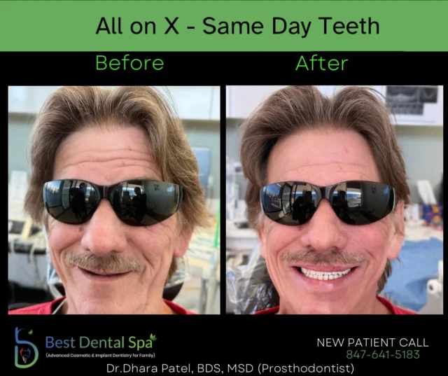 All on X - Dental Implants - Same Day Teeth 
Permanent Teeth. Confident Smile. Life-Changing Results. ✨

Struggling with missing teeth or uncomfortable dentures?
All-on-X Dental Implants offer a fixed, long-term solution—designed to look, feel, and function like natural teeth.

At Best Dental Spa, we create custom full-arch implant solutions using advanced technology in a calm, spa-like environment.

✔️ Fixed, non-removable teeth
✔️ Fewer implants, maximum stability
✔️ Natural aesthetics & improved function
✔️ Financing options available

📍 2505 W Golf Rd, Hoffman Estates, IL 60169
📞 847-641-5183
🌐 Book your All-on-X consultation today 👇
https://bookit.dentrixascend.com/v1/view/organization/2631/index.html?mode=externalLink#/perspectives/3

👉 Limited implant consultations available

#AllOnX #AllOn4 #DentalImplants #FullMouthRehab
SmileTransformation PermanentTeeth ImplantDentistry
BestDentalSpa HoffmanEstatesDentist SchaumburgDentist
ElginDentist IllinoisDentist NoMoreDentures